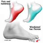 Tarsal Tunnel Syndrome Canberra Heel Pain Institute